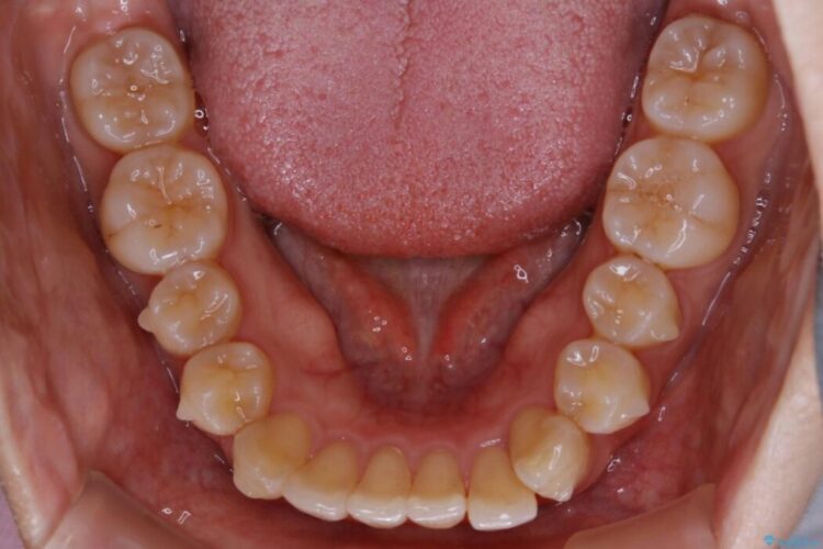 【20代女性】気になる部分だけをマウスピース矯正 治療途中画像