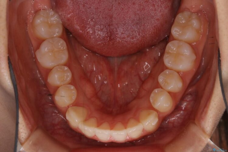 【10代女性】早めに始める受け口（反対咬合）の矯正治療 治療途中画像