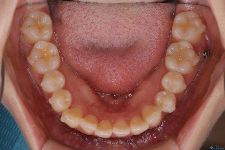 【20代女性】非抜歯でもガタガタを改善するインビザライン矯正 治療途中画像