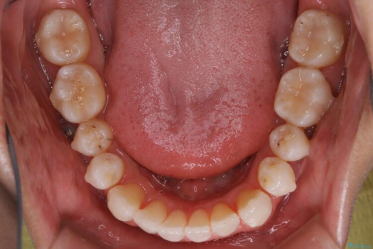 【20代男性】上顎のガタガタな歯列をインビザラインで矯正治療 治療途中画像