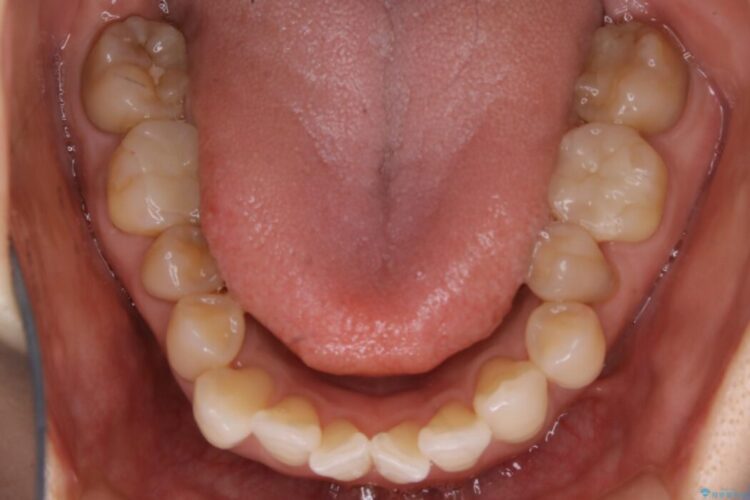 【30代女性】前歯の反対咬合をマウスピースで改善 治療途中画像