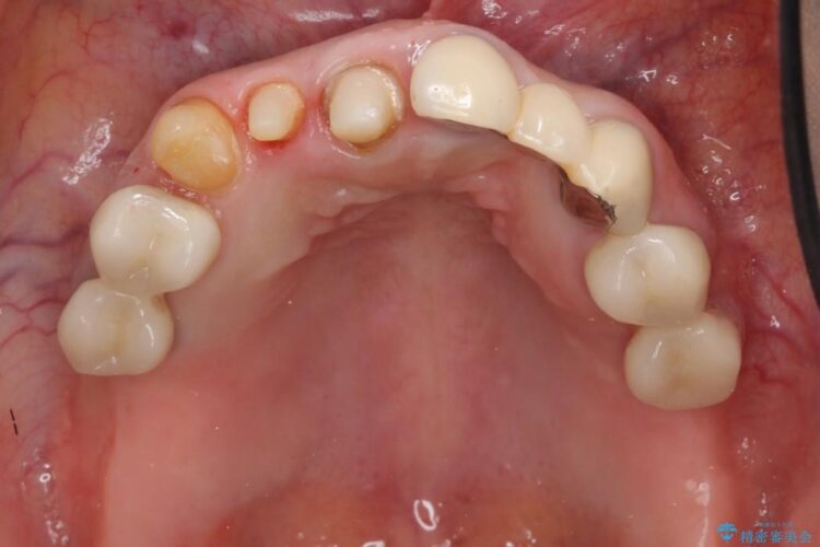 【40代女性】前歯のかぶせ物をセラミックでやりなおす 治療途中画像