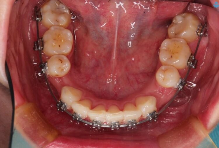 【20代女性】出っ歯の矯正 治療例 治療途中画像