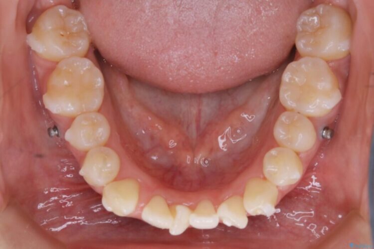 【20代女性】前歯の真ん中（正中）のズレとガタつきを効率よく矯正する 治療途中画像