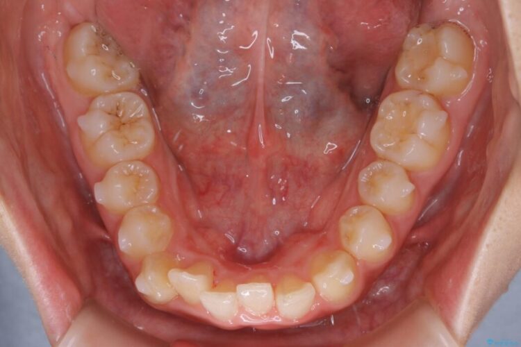 【10代女性】すきっ歯（正中離開）のインビザライン治療 治療途中画像