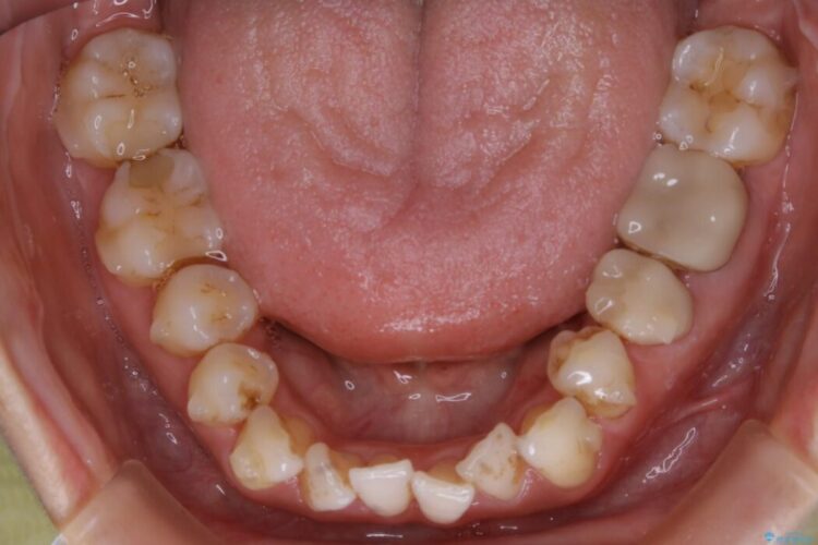 【30代女性】非抜歯で噛み合わせとガタつきの改善 治療途中画像