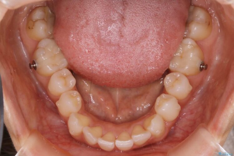 【30代女性】噛み合わせのズレを解消する 治療途中画像