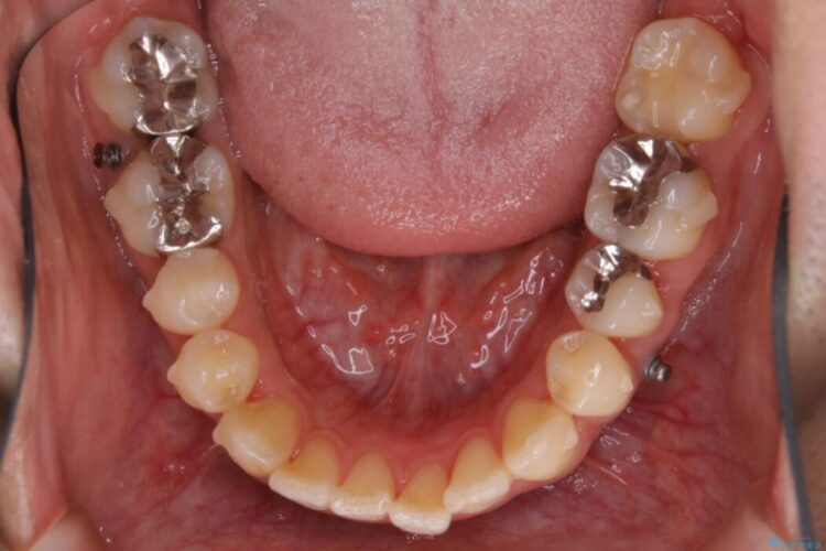 【20代男性】出っ歯をインビザラインで矯正治療 治療途中画像