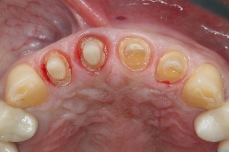 【50代男性】前歯の被せ物を新しく 治療途中画像