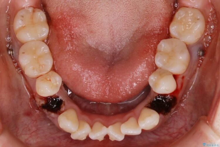 【30代女性】インビザラインで抜歯矯正 治療途中画像