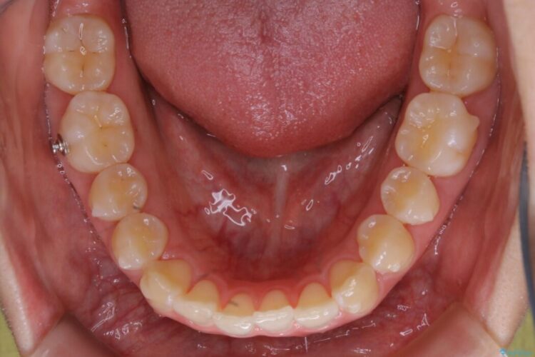 【20代女性】噛み合わせのズレからくるガタついた歯列をインビザライン矯正治療 治療途中画像