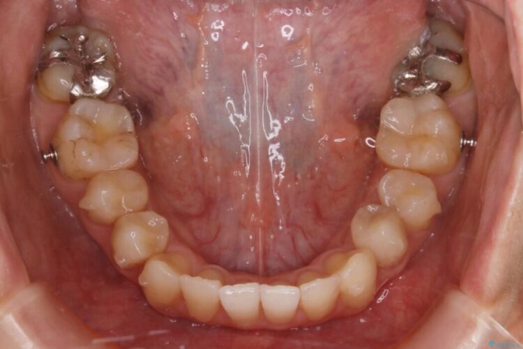 【20代女性】非抜歯で歯列をコンパクトに 治療途中画像