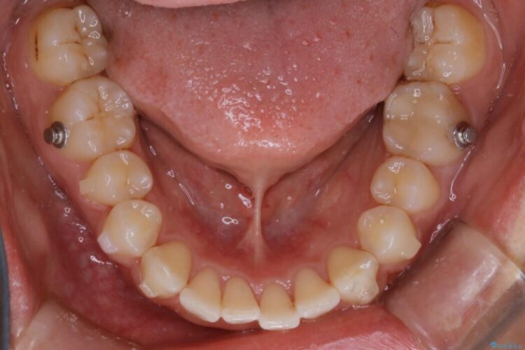 【20代女性】ゴムかけを併用し噛み合わせを改善!インビザライン矯正 治療途中画像