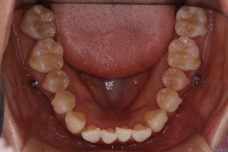 【20代女性】抜歯無しで前歯のがたがたを改善する 治療途中画像