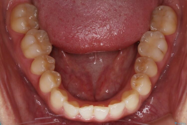 【20代女性】軽度の反対咬合を部分矯正でなおす 治療途中画像