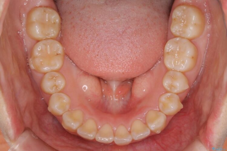 【30代女性】歯を長持ちさせるための咬合調整 治療途中画像