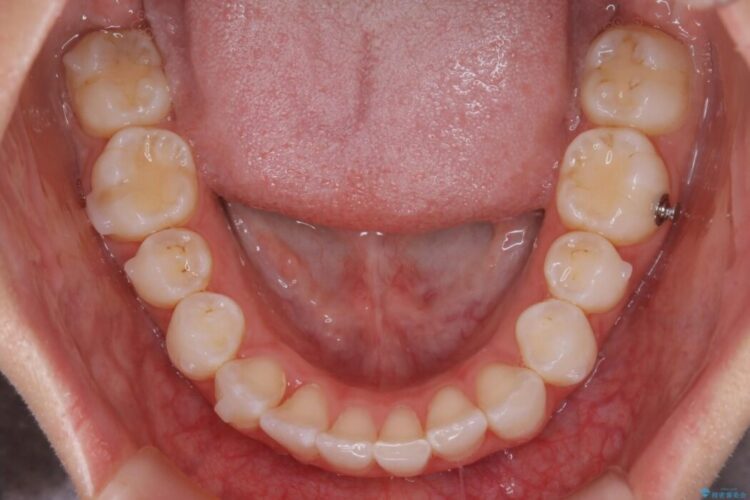 【20代女性】歯軸傾斜を改善して噛み合わせを正しくする 治療途中画像