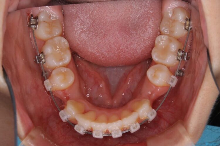 【20代女性】口元を引っ込めたい Eラインの改善 治療途中画像