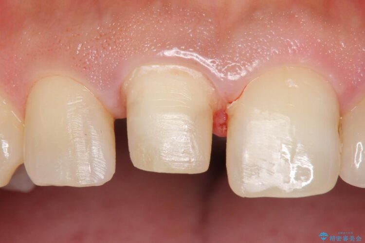 【30代男性】神経一歩手前の深い虫歯をセラミッククラウンで治療 治療途中画像