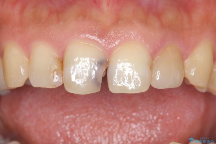 【30代男性】神経一歩手前の深い虫歯をセラミッククラウンで治療 ビフォー