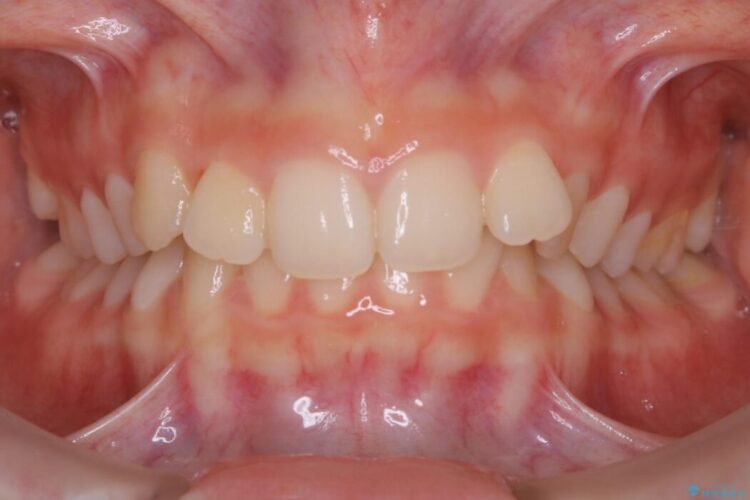 【10代女性】歯並びを整えて自信が持てる素敵な笑顔に 治療前画像