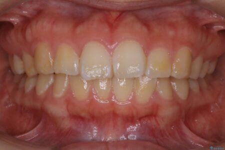 【30代女性】歯を長持ちさせるための咬合調整 治療前