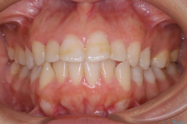 【20代女性】口元を引っ込めたい Eラインの改善 治療前画像