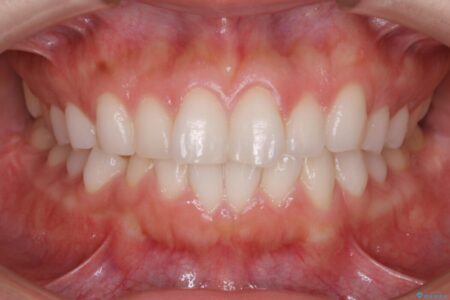 【20代女性】短期間でのインビザライン治療で見た目の悩みを改善する 治療前