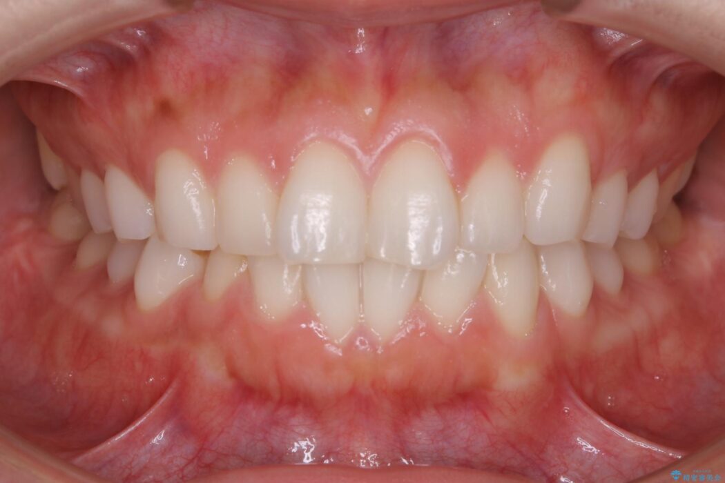 【20代女性】短期間でのインビザライン治療で見た目の悩みを改善する 治療前