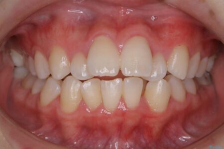 【20代女性】抜歯矯正で出っ張った口元を改善する 治療前