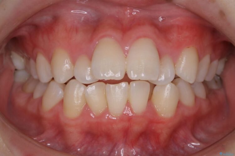 【20代女性】抜歯矯正で出っ張った口元を改善する 治療前画像