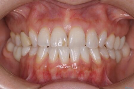 【30代女性】前歯の見た目をセラミッククラウンで変える 治療前