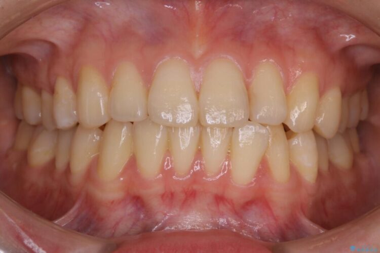 【20代女性】気になる部分だけをマウスピース矯正 治療前画像