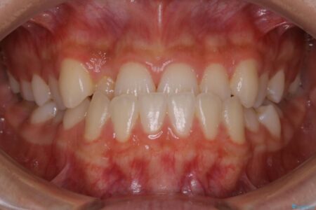 【10代女性】早めに始める受け口（反対咬合）の矯正治療 治療前