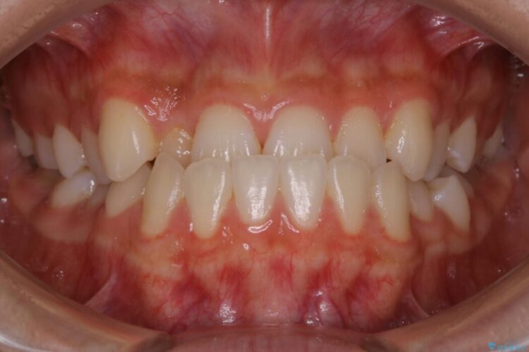 【10代女性】早めに始める受け口（反対咬合）の矯正治療 治療前画像