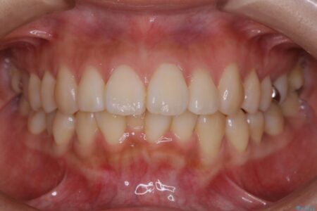 【20代女性】非抜歯でマウスピースの限界に挑戦する矯正治療 治療前