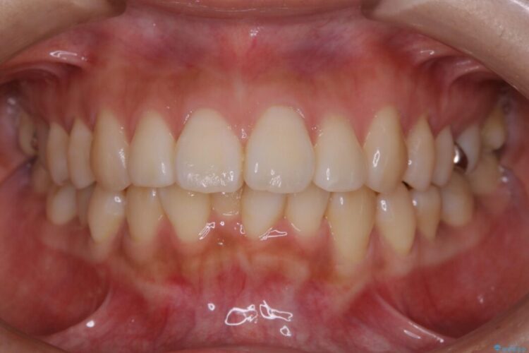 【20代女性】非抜歯でマウスピースの限界に挑戦する矯正治療 治療前画像