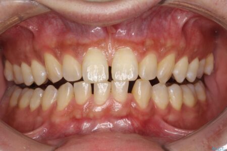 【30代男性】ホワイトニングでできる限り白くしたい 治療前