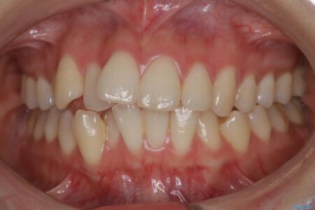 【20代女性】非抜歯でもガタガタを改善するインビザライン矯正 治療前