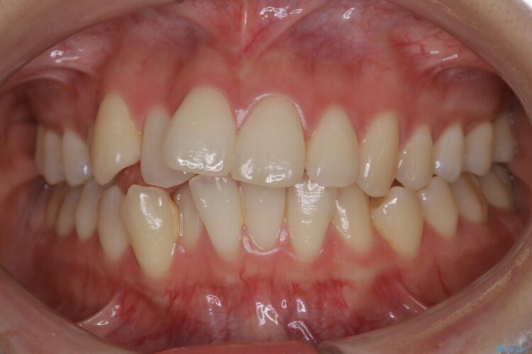 【20代女性】非抜歯でもガタガタを改善するインビザライン矯正 治療前画像