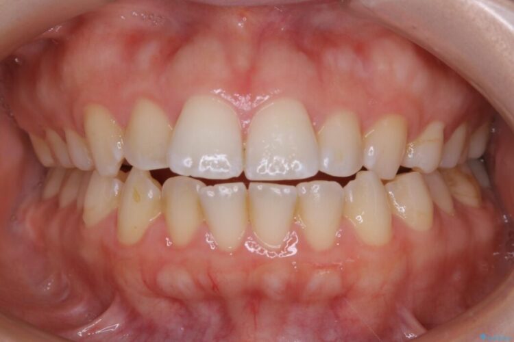 【20代女性】前歯が噛み合わない!開咬（オープンバイト）の矯正治療 治療前画像