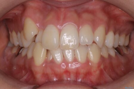 【20代女性】隠れた前歯とガタつきをきれいな歯列弓へ 治療前