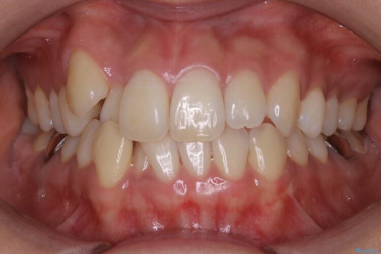 【20代女性】隠れた前歯とガタつきをきれいな歯列弓へ 治療前画像