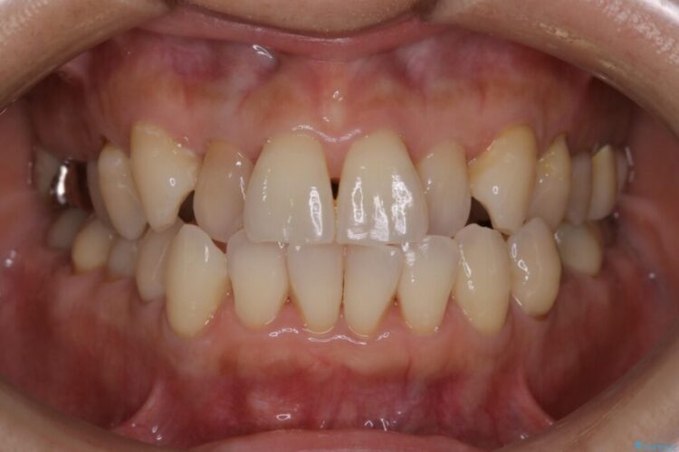 【30代女性】前歯の反対咬合をマウスピースで改善 ビフォー