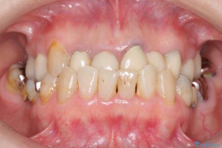 【40代女性】前歯のかぶせ物をセラミックでやりなおす 治療前