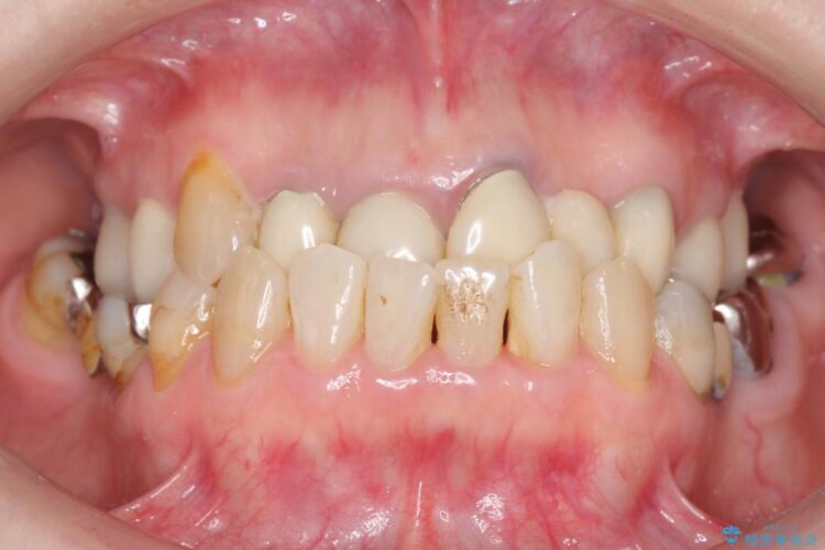 【40代女性】前歯のかぶせ物をセラミックでやりなおす 治療前画像