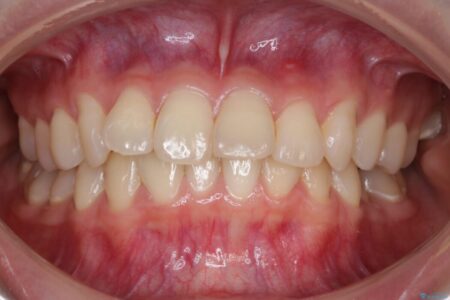 【20代女性】ブライダルに向けた矯正できれいなスマイルラインへ 治療前