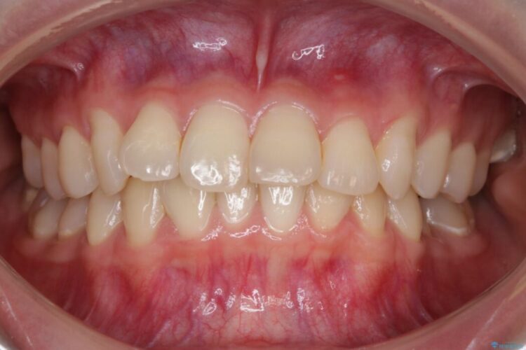 【20代女性】ブライダルに向けた矯正できれいなスマイルラインへ 治療前画像