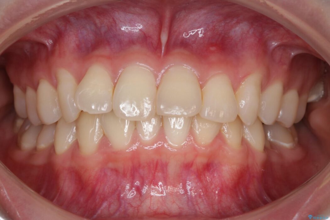 【20代女性】ブライダルに向けた矯正できれいなスマイルラインへ 治療前