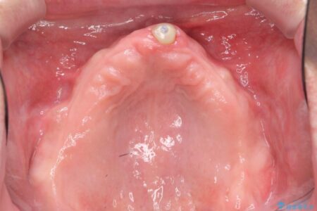 【50代男性】重度の歯周病をインプラントを用いた上顎義歯（入れ歯）で補綴治療 治療前